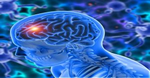 Brain tumor