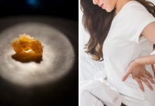 Kidney stones