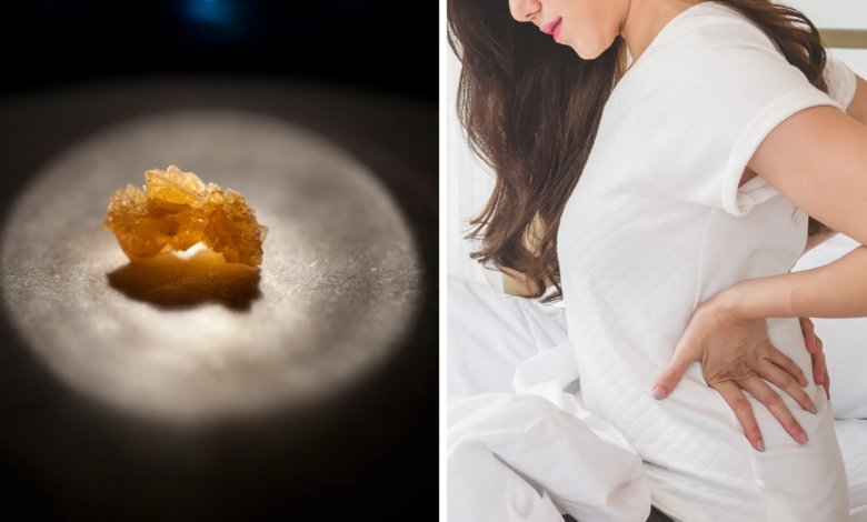 Kidney stones