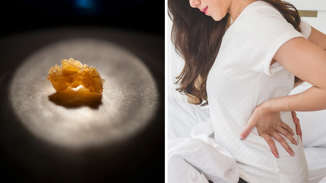 Kidney stones