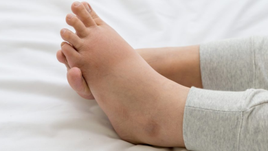 Swollen feet