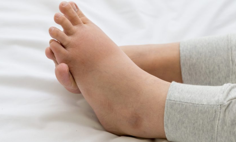 Swollen feet