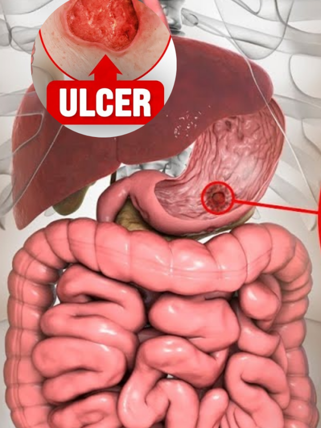 ulcer: అల్సర్లకు చెక్ పెట్టాలంటే..