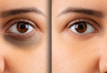 Dark circles