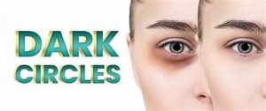 Dark circles