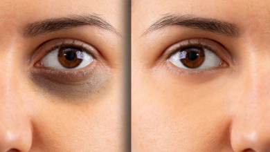 Dark circles