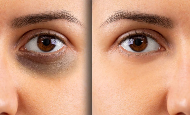 Dark circles