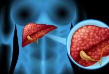 Fatty liver
