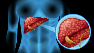 Fatty liver