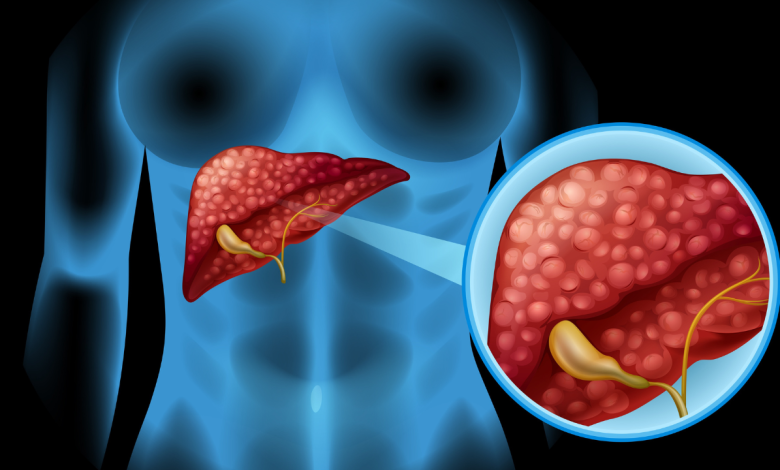 Fatty liver