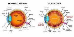 Glaucoma