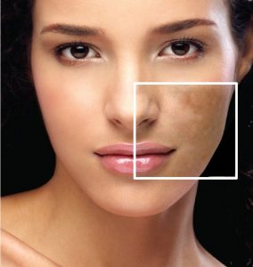 Melasma