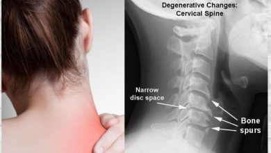 Neck Pain