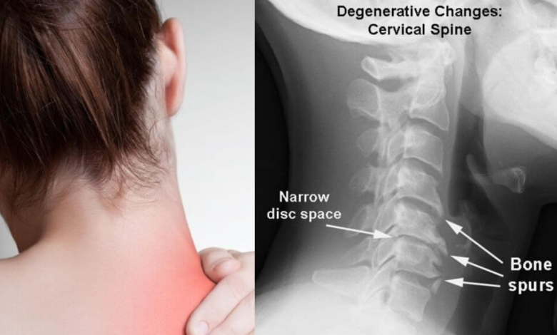 Neck Pain